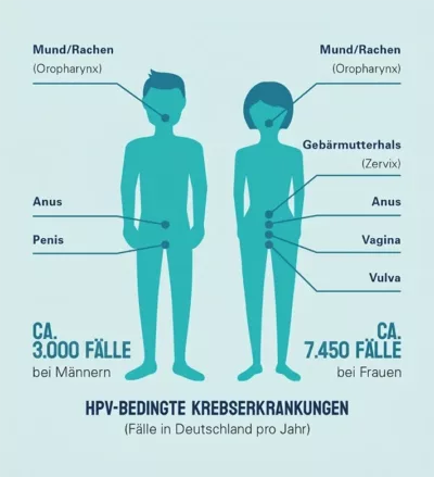 Krankheiten, die durch HPV ausgelöst werden können: Bei Jungen: Mund/Rachen, Anus, Penis. Bei Mädchen: Mund/Rachen, Gebärmutterhals, Anus, Vagina, Vulva
